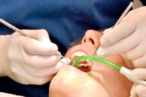 10 साल के बच्चे के मुंह में थे 50 दांत, डॉक्टरों ने ढाई घंटे ऑपरेशन के बाद उखाड़े 30 दांत
