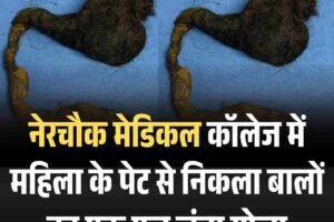 नेरचौक मेडिकल कॉलेज में महिला के पेट से निकला बालों का एक फुट लंबा गोला