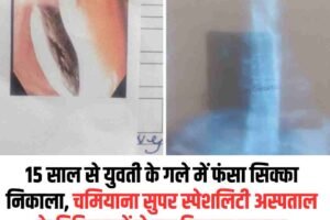 15 साल से युवती के गले में फंसा सिक्‍का निकाला, चमियाना सुपर स्पेशलिटी अस्पताल के चिकित्‍सकों ने कर दिखाया कमाल